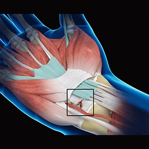 Picture of Wrist Ligament Tear and Instability
