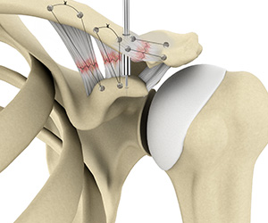 AC Joint Repair - Educational Picture