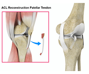 ACL Reconstruction - Educational Picture