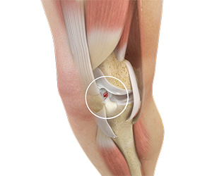 ACL Tears - Educational Picture