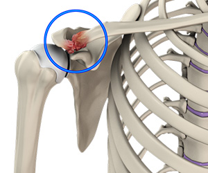 Acromioclavicular (AC) Joint Osteoarthritis - Educational Picture