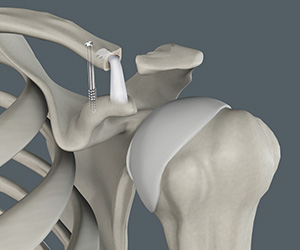 Acromioclavicular (AC) Joint Reconstruction - Educational Picture
