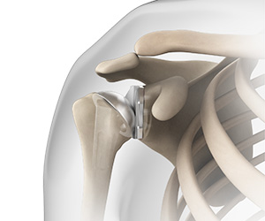 Anatomic Shoulder Replacement - Educational Picture