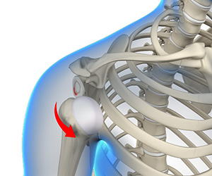 Anterior Shoulder Instability - Educational Picture