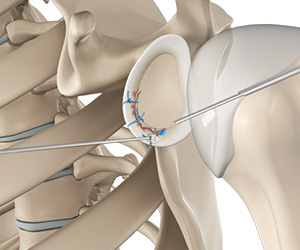 Arthroscopic Bankart Repair - Educational Picture