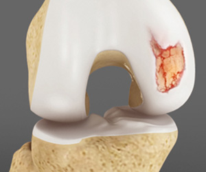 Articular Cartilage Injury (Knee) - Educational Picture