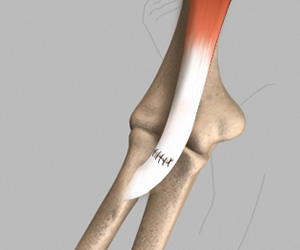 Biceps Tendon Repair - Educational Picture