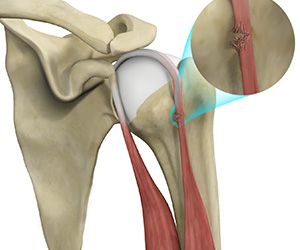 Bicep Tendon Rupture at Shoulder - Educational Picture