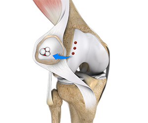 Cartilage Restoration of the Patellofemoral Joint - Educational Picture
