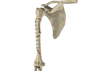 Complex Fracture Repair of the Shoulder - Educational Picture