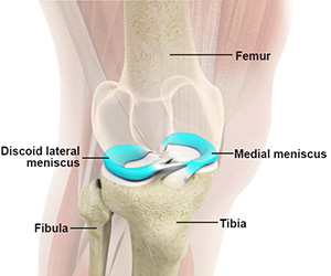 Discoid Meniscus - Educational Picture