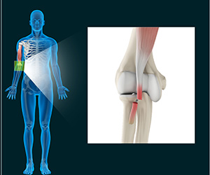 Distal Biceps Injuries - Educational Picture