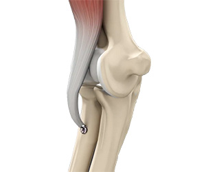 Distal Biceps Repair - Educational Picture