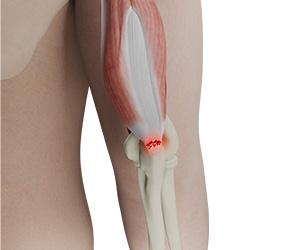 Distal Triceps Tear - Educational Picture