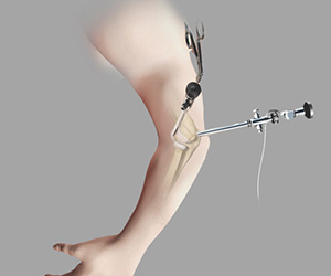 Elbow Arthroscopy - Educational Picture