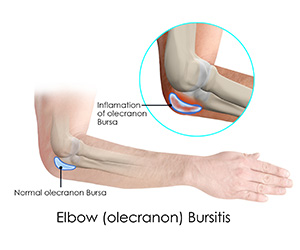 Elbow (Olecranon) Bursitis - Educational Picture