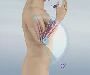 Elbow Contracture - Educational Picture