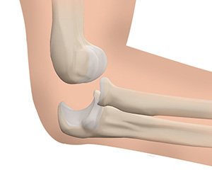 Elbow Dislocation - Educational Picture