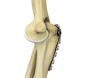 Elbow Fracture Reconstruction - Educational Picture