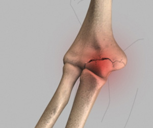 Elbow Fractures - Educational Picture