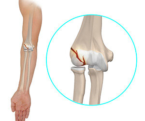 Elbow Injuries - Educational Picture