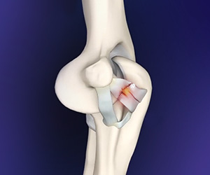 Elbow Ligament Injuries - Educational Picture