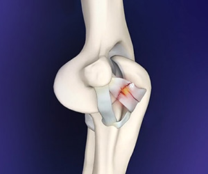 Elbow Ligament Reconstruction - Educational Picture
