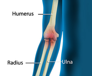 Elbow Pain - Educational Picture
