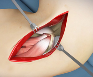 Elbow Surgery - Educational Picture