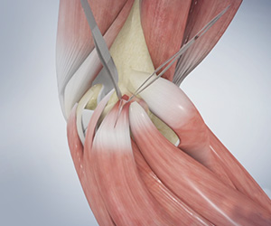 Golfer's Elbow Surgery - Educational Picture
