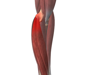 Golfer's Elbow - Educational Picture