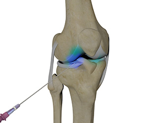 Intraarticluar Knee Injection - Educational Picture