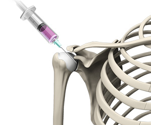 Intraarticular Shoulder Injection - Educational Picture