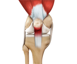 Jumper's Knee - Educational Picture