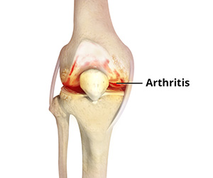 Knee Arthritis - Educational Picture