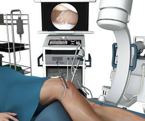 Knee Arthroscopy - Educational Picture