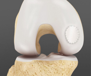Knee Cartilage Restoration - Educational Picture