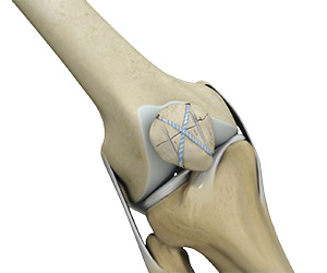 Knee Fracture Surgery - Educational Picture