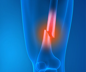 Knee Fracture - Educational Picture