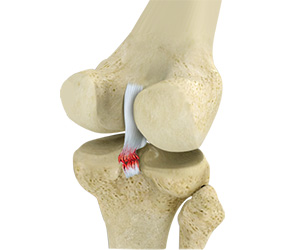 Knee Ligament Injuries - Educational Picture
