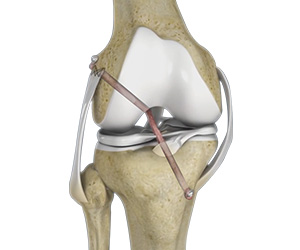 Knee Ligament Reconstruction - Educational Picture