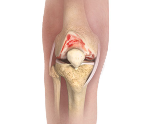 Knee Osteoarthritis Treatment - Educational Picture
