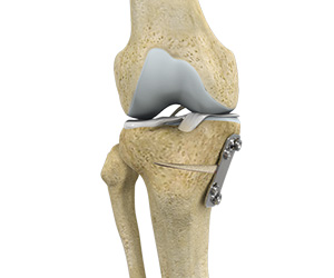 Knee Osteotomy - Educational Picture