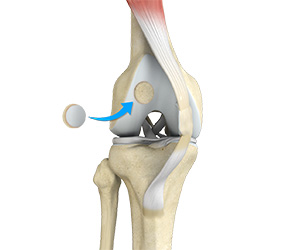 Knee Preservation Surgery - Educational Picture