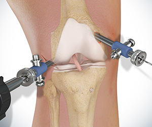 Knee Surgery - Educational Picture