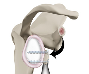 Latarjet Procedure - Educational Picture