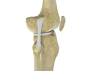 Lateral Collateral Ligament (LCL) Tear - Educational Picture