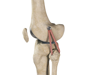 LCL Reconstruction - Educational Picture
