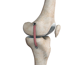 MCL Reconstruction - Educational Picture