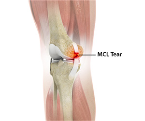 MCL Tears - Educational Picture